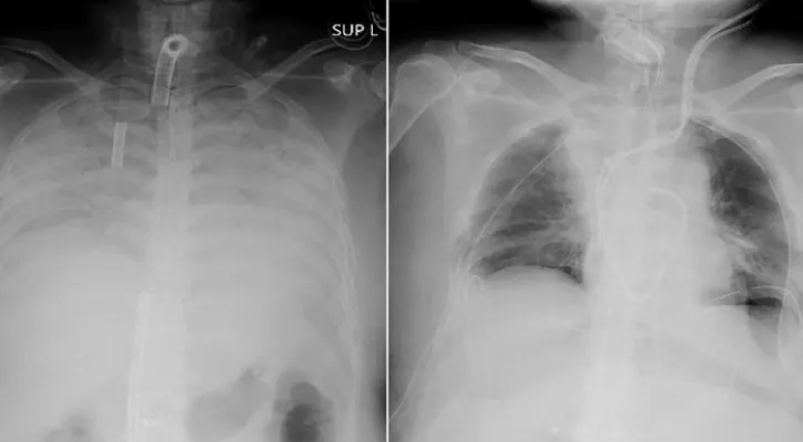 Begini Penampakan Paru-Paru (Foto: Kyoto University Hospital/AP)