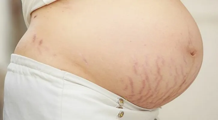 Ilustrasi Stretch Marks (Foto/pinterest/@momjunction)