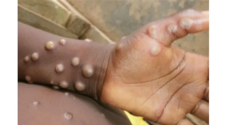 Gejala Monkeypox (cacar monyet) pada manusia. (Foo/Intenet/TST)