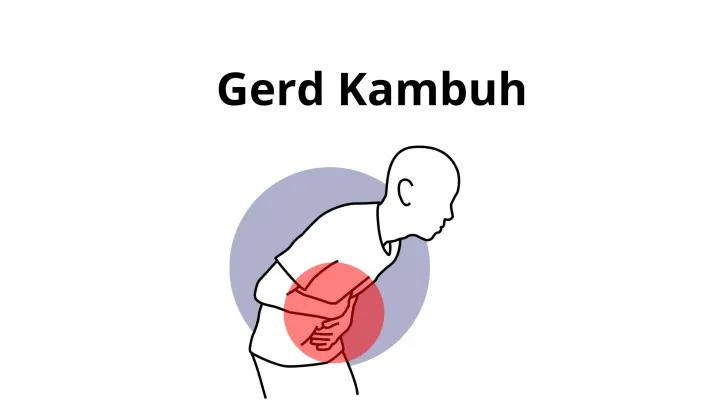 Penanganan gerd kambuh yang harus dilakukan.