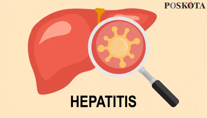 Ilustrasi hepatitis akut. (ilustrator: poskota/Suroso imam utomo)