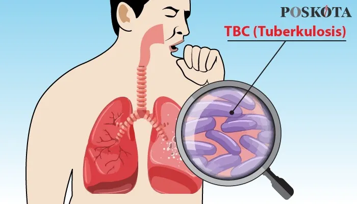 Ilustrasi TBC alias Tuberkulosis Menteri Kesehatan RI Sebut 969 ribu masyarakat terkena TBC. (Dok. Poskota)